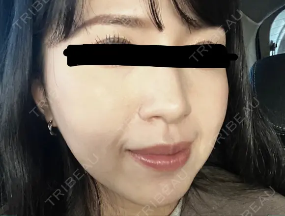 イオン導入 椿クリニック 名古屋院 BEFORE メイン用