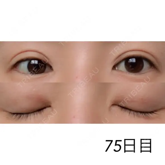 二重埋没 / 目元修正 湘南美容クリニック 広島院 BEFORE メイン用