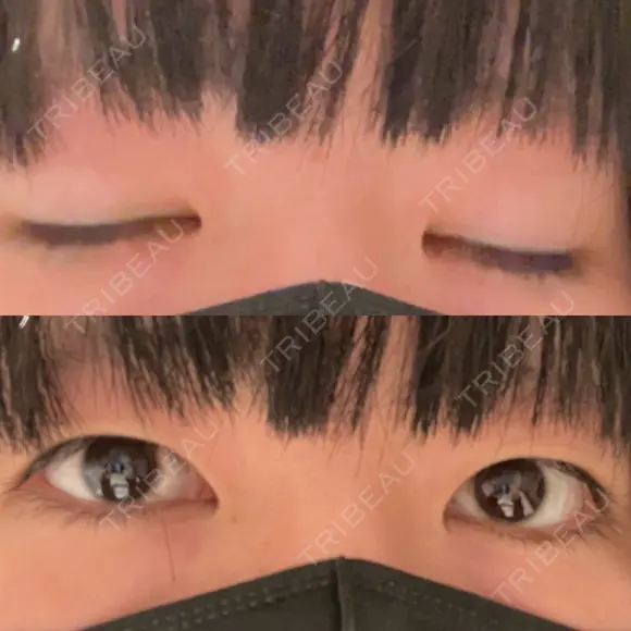 二重埋没 / ハイフ（顔） 日本ウェルネス再生クリニック BEFORE メイン用