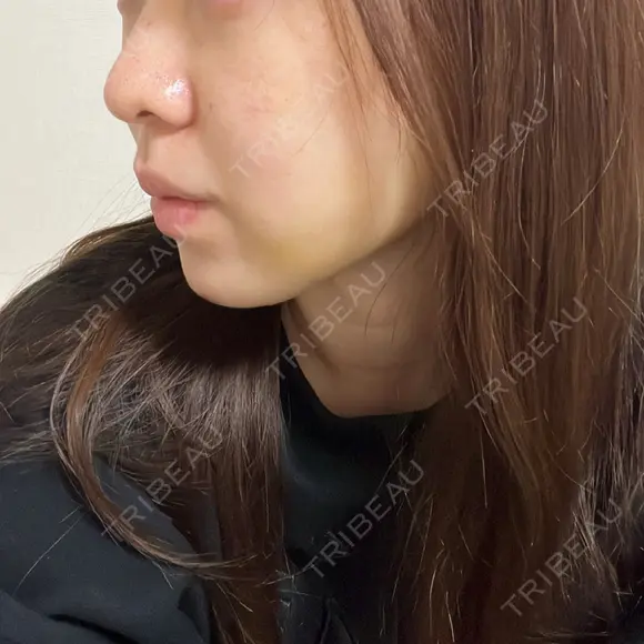 ピーリング（ニキビ・毛穴） / 光治療（フォトフェイシャルなど） RAISE CLINIC 【レイズクリニック】 BEFORE メイン用