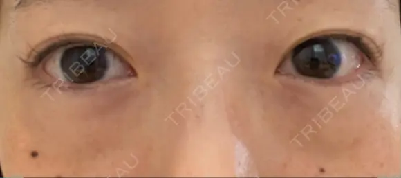 下まぶたたるみ取り / 下まぶたの脂肪取り 湘南美容クリニック 京都院 BEFORE メイン用