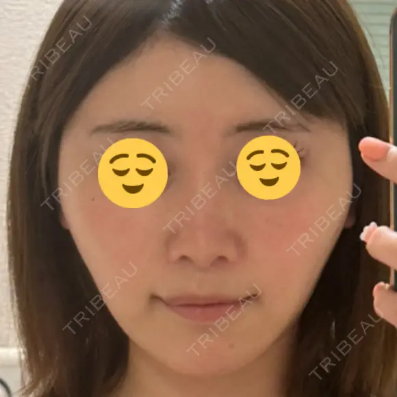 ヒアルロン酸注入（唇） / ヒアルロン酸注入（額） / ヒアルロン酸注入（頬） / ヒアルロン酸注入（こめかみ） ziz CLINIC BEFORE メイン用