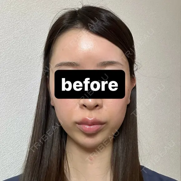 糸リフト / 脂肪吸引（顔） / ヒアルロン酸注入（あご） / ヒアルロン酸注入（こめかみ） BLINC CLINIC （ブリンク クリニック） BEFORE メイン用