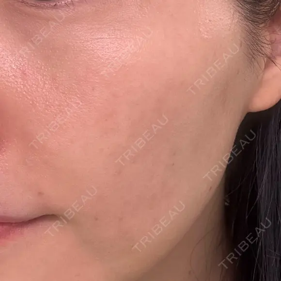 ピコレーザートーニング（美白・肝斑） / フラクショナルレーザー（毛穴・ニキビ跡） おおかみ美容のクリニック 新宿院 BEFORE メイン用