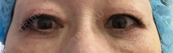 眼瞼下垂（切開） 札幌中央形成外科 BEFORE メイン用