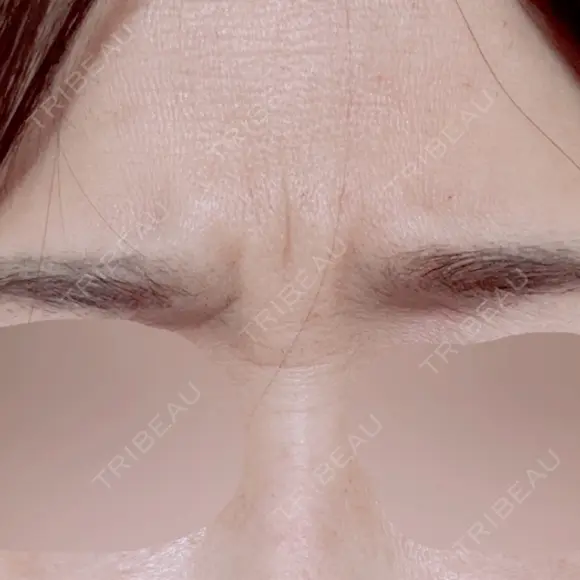 ボトックス（眉間） / ボトックス（額） 日本ウェルネス再生クリニック BEFORE メイン用