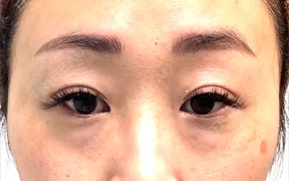 クマ治療 / 下まぶたの脂肪取り コスメディカルクリニック シンシア 銀座院 BEFORE メイン用
