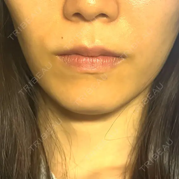 ヒアルロン酸注入（鼻翼基部） KAGA CLINIC BEFORE メイン用