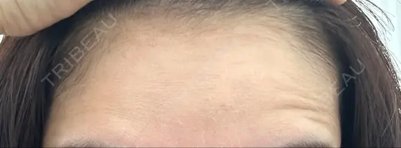 ボトックス（額） TCB東京中央美容外科 岡山院 BEFORE メイン用