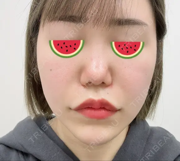 ボトックス（エラ・小顔） / ヒアルロン酸注入（頬） 高崎TAクリニック BEFORE メイン用