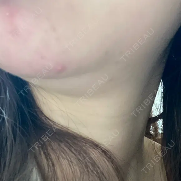 ハイフ（顔） 表参道メディカルクリニック 銀座院 BEFORE メイン用