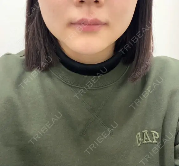 ボトックス（エラ・小顔） TCB東京中央美容外科 京都駅前院 BEFORE メイン用