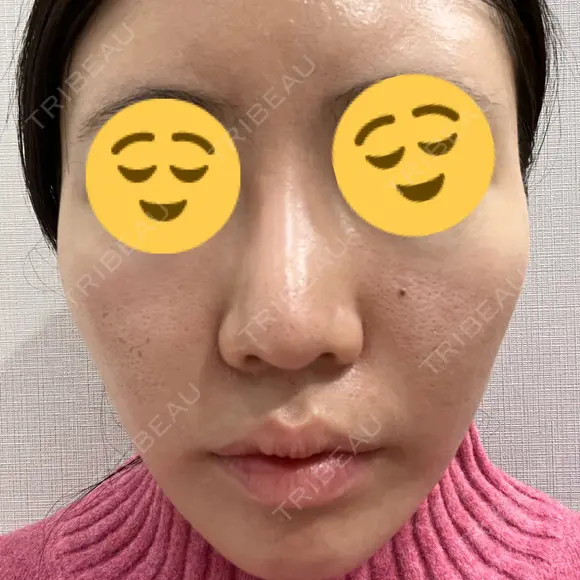 その他（肌） / 美肌レーザー 湘南美容クリニック 静岡院 BEFORE メイン用