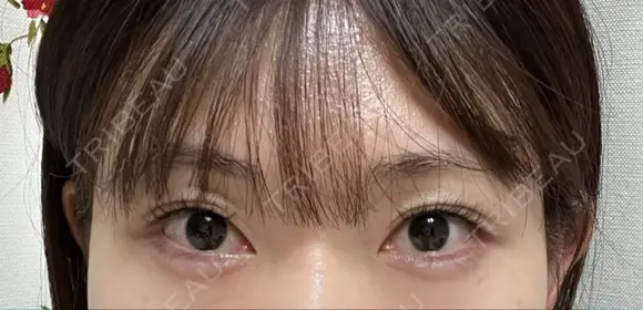 ボトックス（肩） / ヒアルロン酸注入（目の下） ルラ美容クリニック 神戸院 BEFORE メイン用