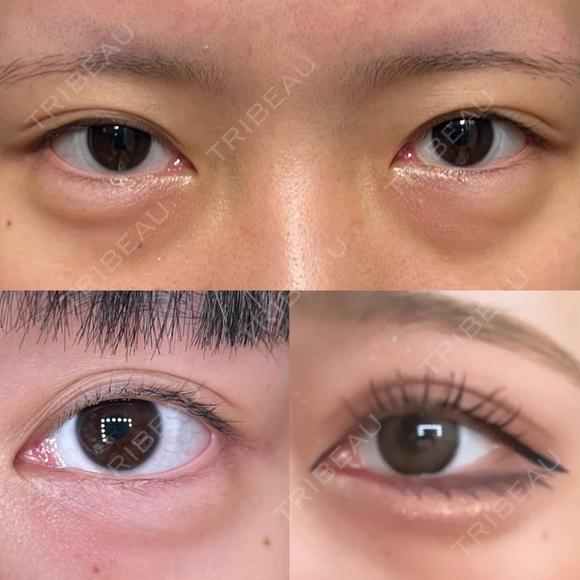 二重切開 / 目頭切開 / クマ治療 / 目尻切開 / 上まぶたたるみ取り / 下まぶたの脂肪取り / 脂肪注入（目の下） 湘南美容クリニック 大阪堺東院 BEFORE メイン用
