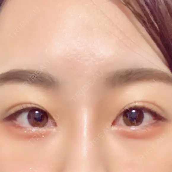 クマ治療 / ボトックス（エラ・小顔） / ヒアルロン酸注入（頬） TCB東京中央美容外科 京都駅前院 BEFORE メイン用