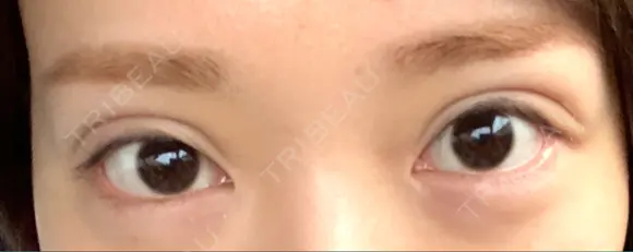 二重切開 郡山タウン形成外科クリニック BEFORE メイン用