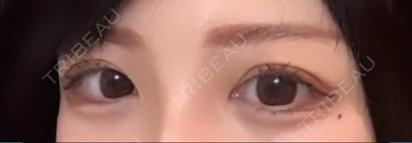 二重切開 / 目頭切開 / 眼瞼下垂（切開） / 上まぶたの脂肪取り エターナル美容クリニック BEFORE メイン用