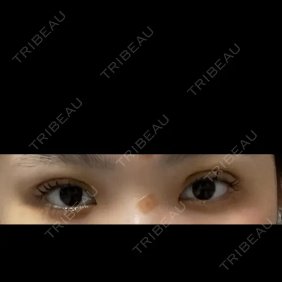 目尻切開 / 目尻靭帯移動 S.T styleクリニック BEFORE メイン用