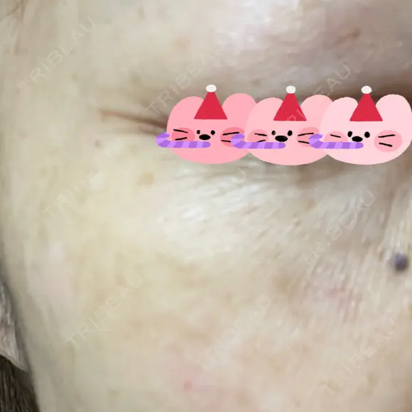 リジュラン 東京ココセランクリニック BEFORE メイン用