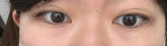 クマ治療 湘南美容クリニック 仙台院 BEFORE メイン用