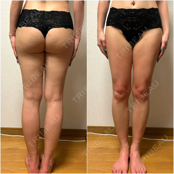 脂肪吸引（脚） / 豊胸（脂肪注入） GAYA body design clinic BEFORE メイン用