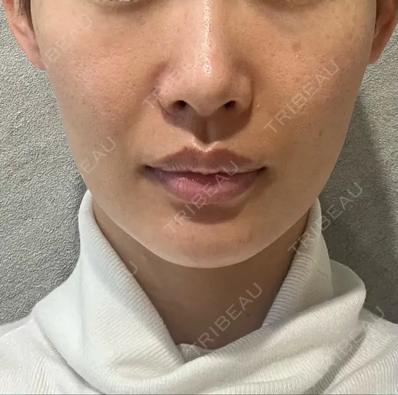 脂肪吸引注射（顔） ziz CLINIC BEFORE メイン用