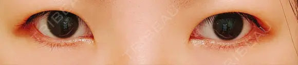 二重埋没 水の森美容クリニック 東京銀座院 BEFORE メイン用