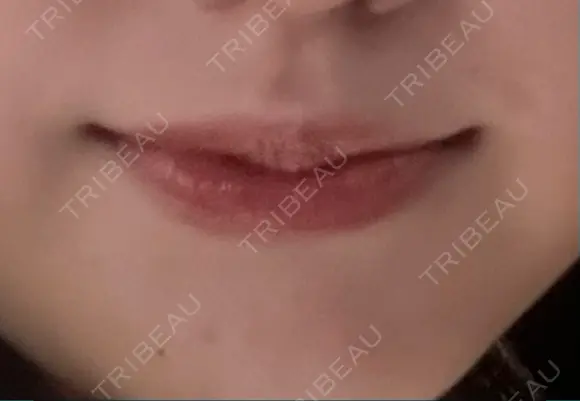 ヒアルロン酸注入（唇） 銀座美容外科クリニック 新宿院 BEFORE メイン用