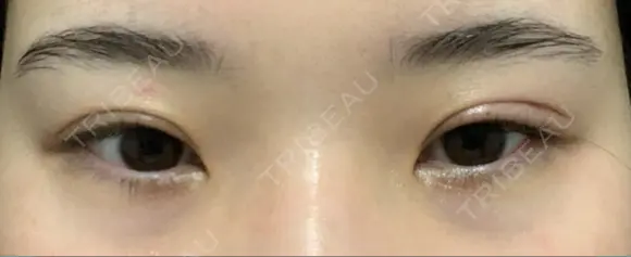 目頭切開 ziz CLINIC BEFORE メイン用
