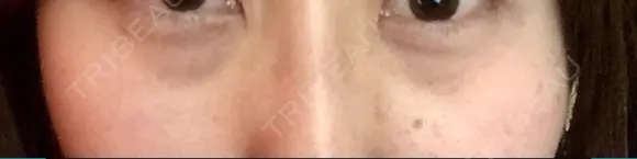 クマ治療 / 下まぶたたるみ取り 二子玉川美容外科クリニック BEFORE メイン用