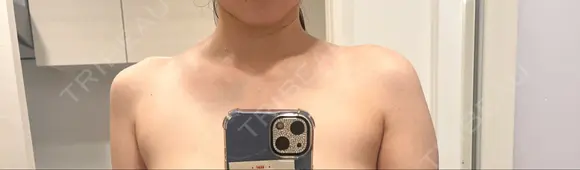 ボトックス（肩） / ボトックス（首） L‘amour clinic Tokyo【ラムールクリニック東京】 BEFORE メイン用