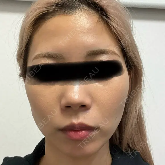 ボトックス（あご） / ボトックス（エラ・小顔） / ボトックス（口角） / ボトックス（眉間） / ボトックス（額） M'sクリニック【エムズクリニック】 BEFORE メイン用