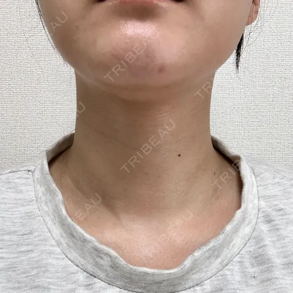 ハイフ（首） 湘南美容クリニック 新宿南口院 BEFORE メイン用