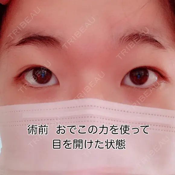 二重切開 / 眼瞼下垂（切開） 広島プルミエクリニック BEFORE メイン用