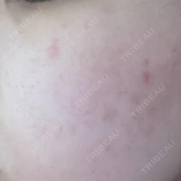 光治療（フォトフェイシャルなど） 美容皮膚科エルムクリニック 福岡院 BEFORE メイン用