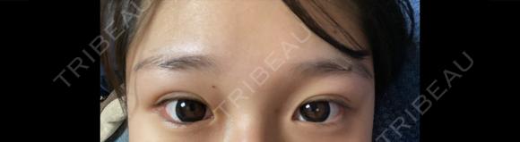 目頭切開 KAUNIS CLINIC（カウニスクリニック） BEFORE メイン用