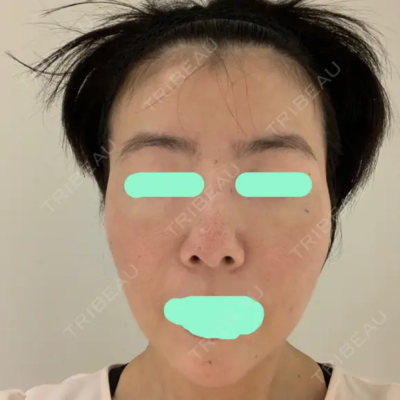 その他（肌） / ダーマペン スキンリファインクリニック銀座 BEFORE メイン用