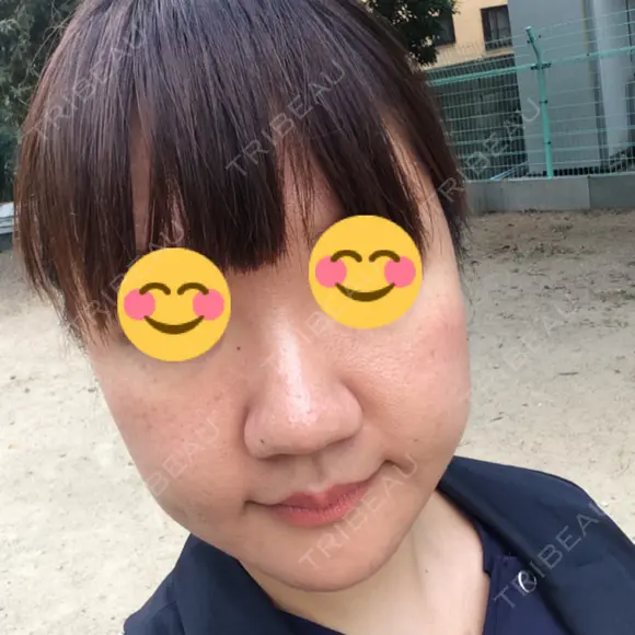 鼻尖形成（切開） / 小鼻縮小（切開） / 鼻尖縮小 湘南美容クリニック 神戸院 BEFORE メイン用