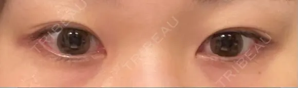 ヒアルロン酸注入（涙袋） KAGA CLINIC BEFORE メイン用