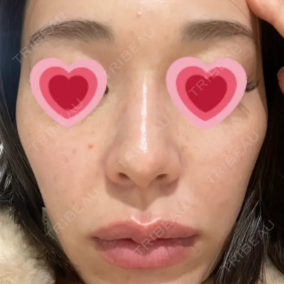 水光注射（ハリ・美肌） 赤羽ここちクリニック BEFORE メイン用