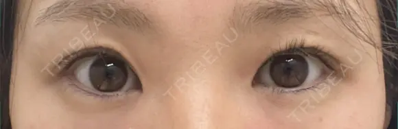 二重埋没 OMI CLINIC 【オミクリニック】 BEFORE メイン用