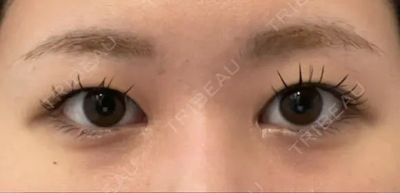 眼瞼下垂（切開） 水の森美容クリニック 福岡院 BEFORE メイン用