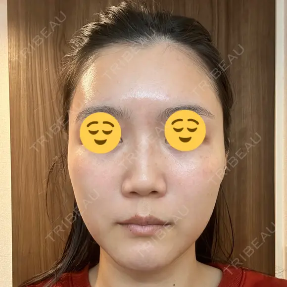 ボトックス（眉間） スキンリファインクリニック銀座 BEFORE メイン用