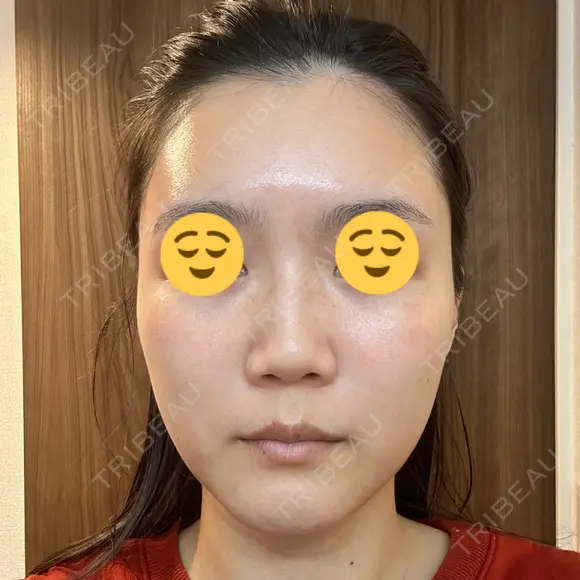 ボトックス（エラ・小顔） スキンリファインクリニック銀座 BEFORE メイン用