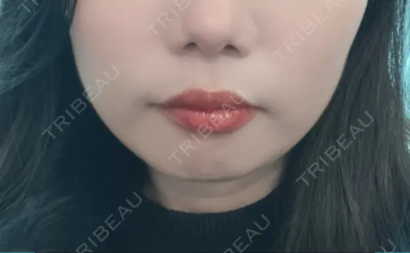脂肪溶解注射（顔） SK新宿歌舞伎町美容外科・歯科 BEFORE メイン用
