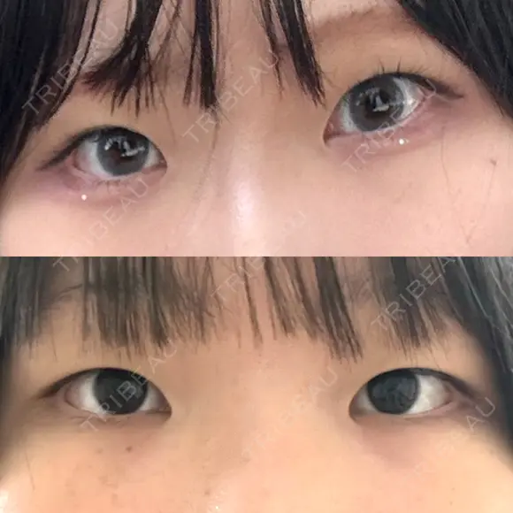 二重埋没 / 目頭切開 シンデレラ＆ダヴィンチクリニック BEFORE メイン用