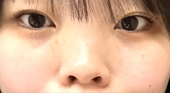 二重埋没 / 目頭切開 / 鼻尖形成（切開） / 軟骨移植 / 眉間プロテーゼ / 鼻尖縮小 グローバルビューティークリニック 大阪院 BEFORE メイン用
