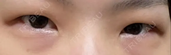 二重切開 / 目頭切開 / 上まぶたたるみ取り 湘南美容クリニック 大阪堺東院 BEFORE メイン用