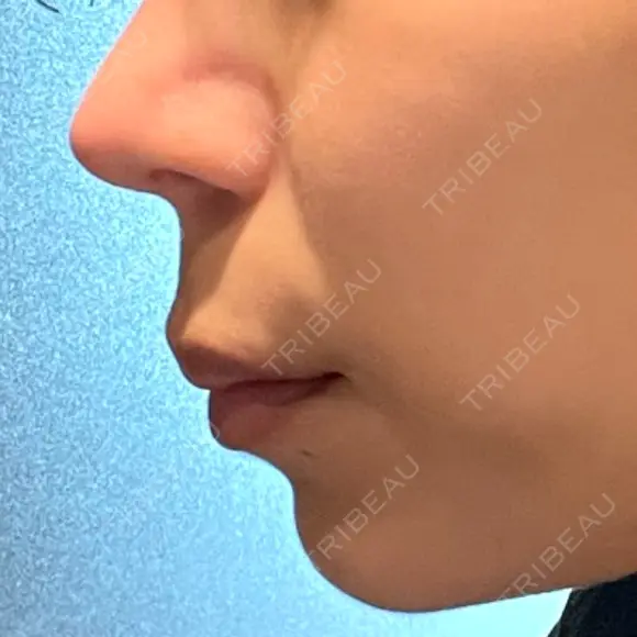 人中短縮 / その他（鼻） 聖心美容クリニック 六本木院 BEFORE メイン用